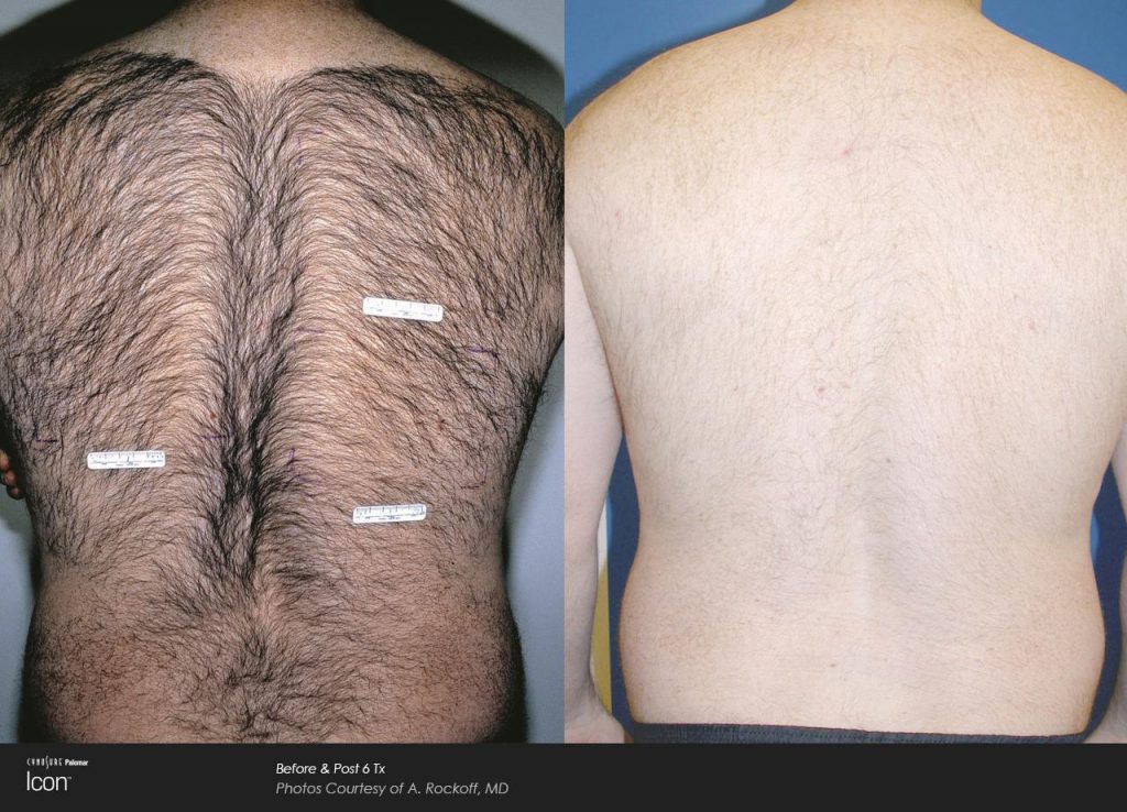 Middlesex County Laser Hair Removal | Park Avenue Aesthetics