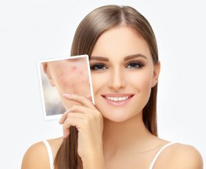 MicroNeedling Middlesex County